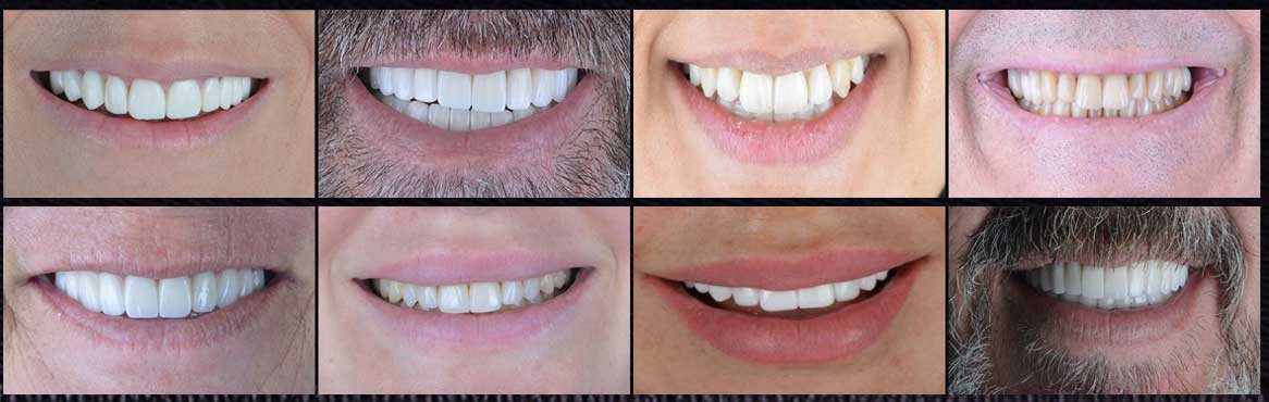 A collage of 8 close-up photos showing diverse patient smiles after receiving successful smile makeovers in Turkey.