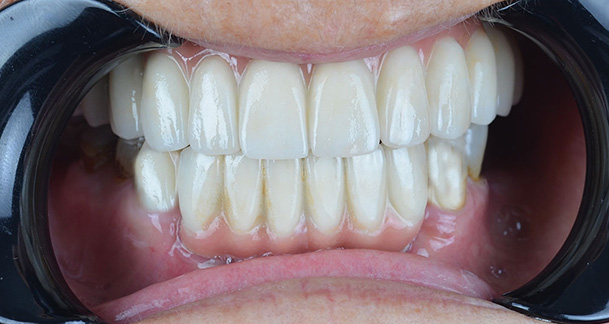 All on Four Dental Implants After