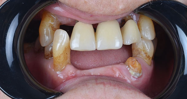 All of Four Dental Implants Before