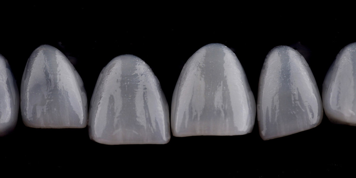 Ceramic Laminate Veneers