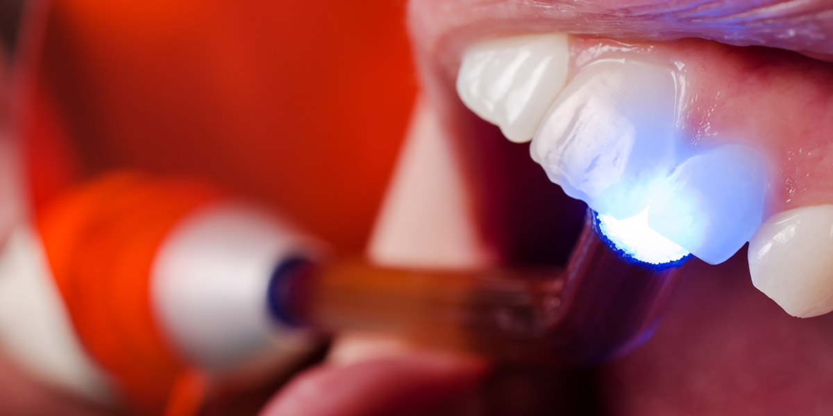 Composite Bonding Curing Light