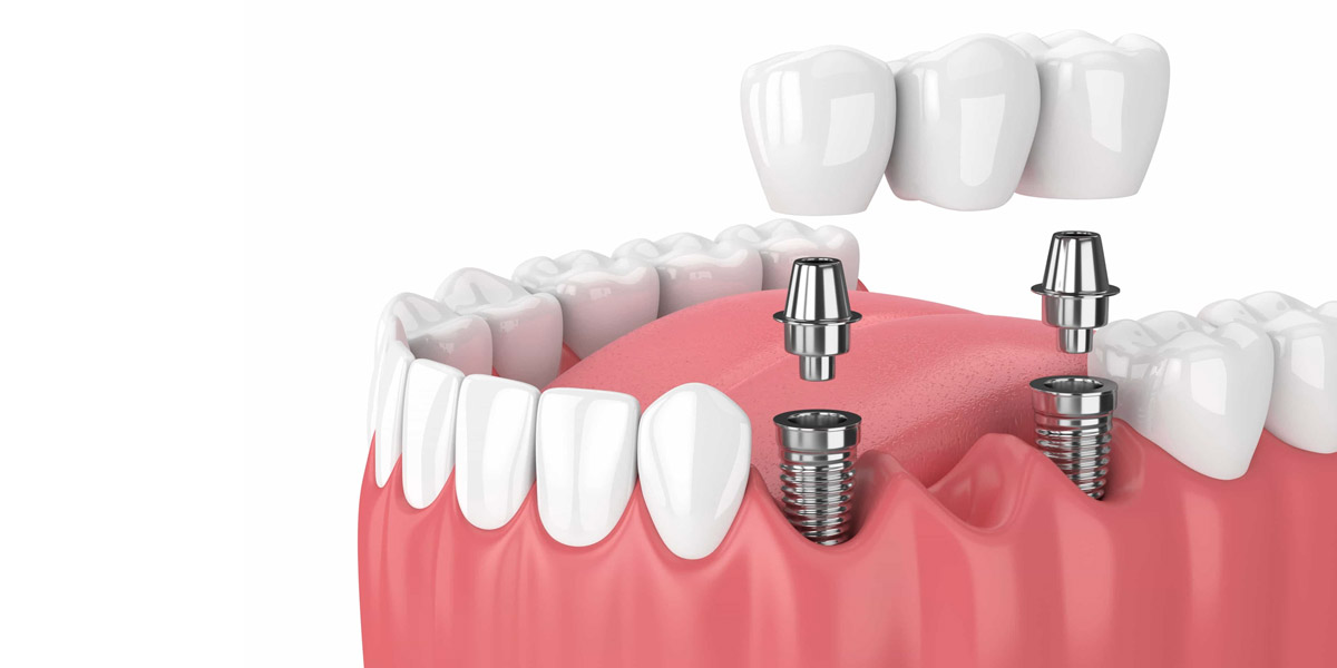 Dental Implants Supported Bridge