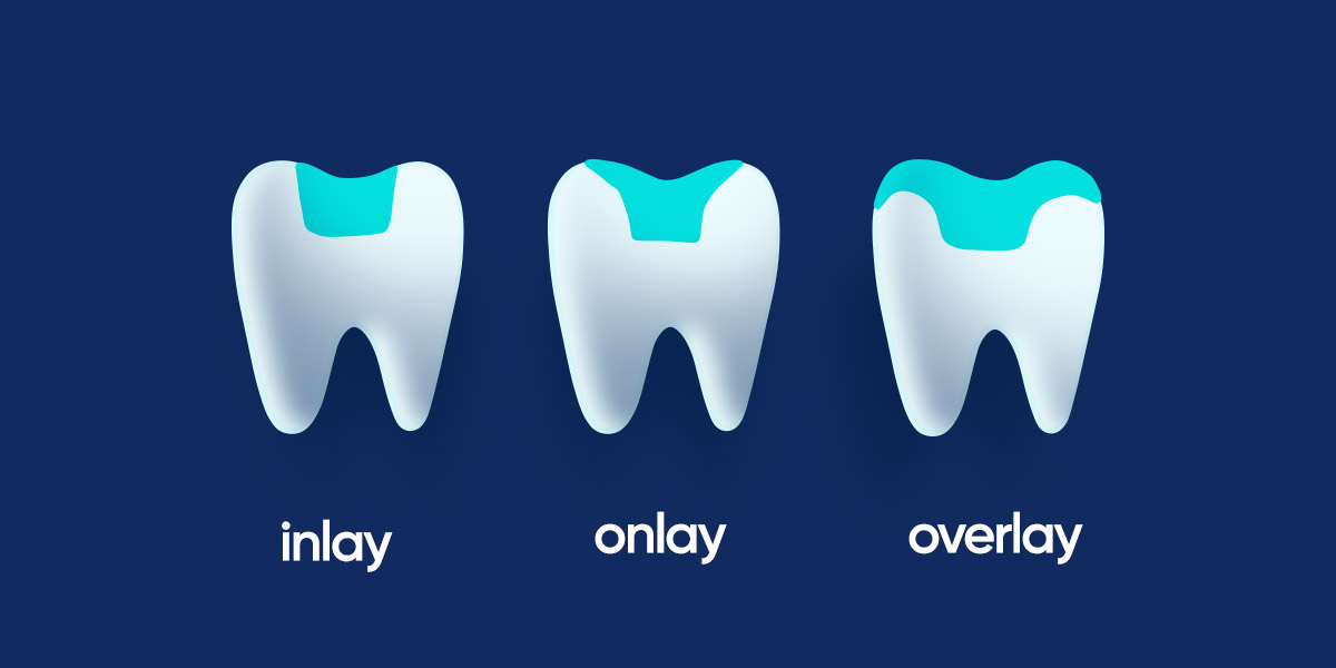 Dental Inlay & Onlay & Overlay