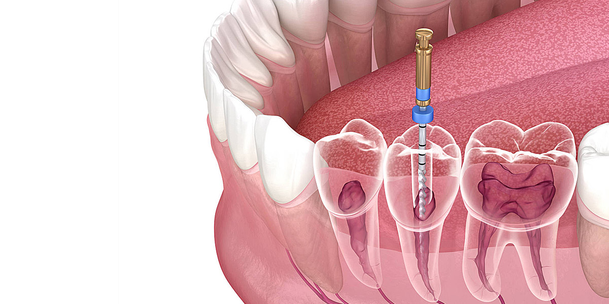 Endodontic Root Canal Treatment