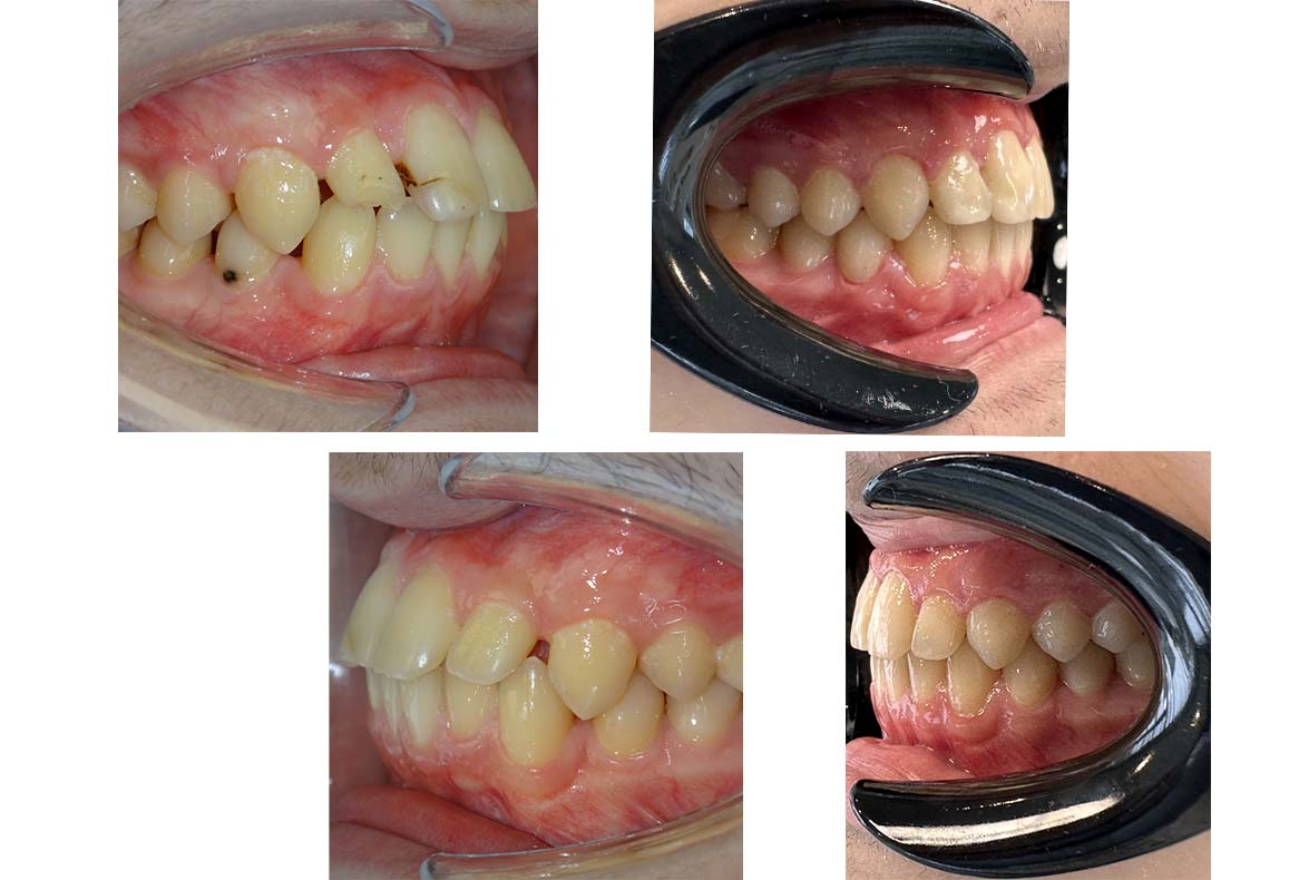 Glenn's Invisalign Turkey Before After