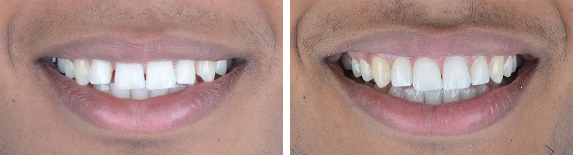 Manuel's Invisalign Turkey Before After