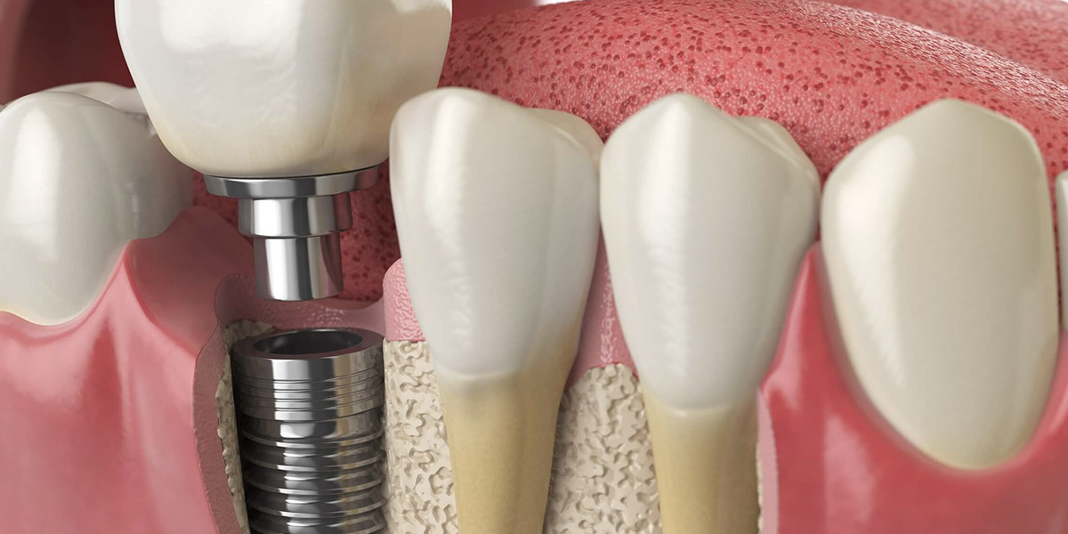 Sngle Dental Implant