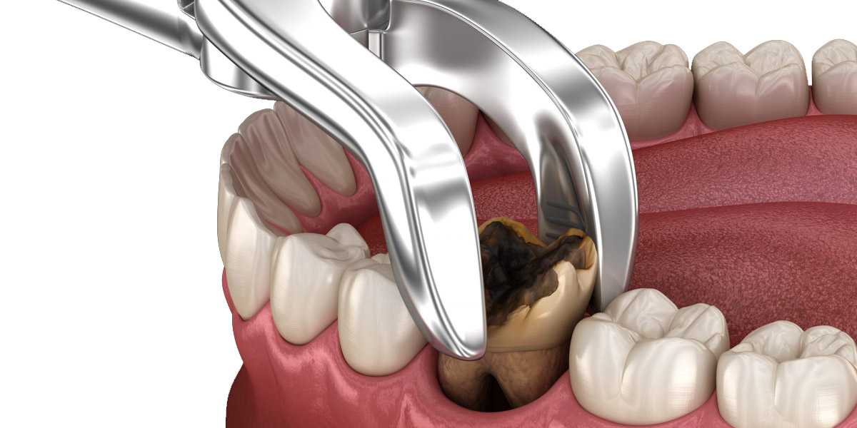Tooth Removal