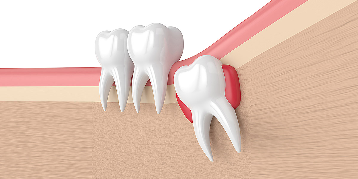 Impacted Tooth