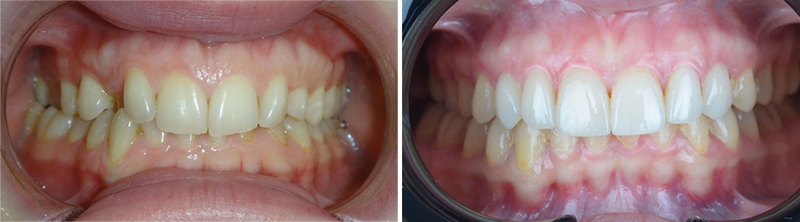 Invisalign and Veneers Hollywood Smile