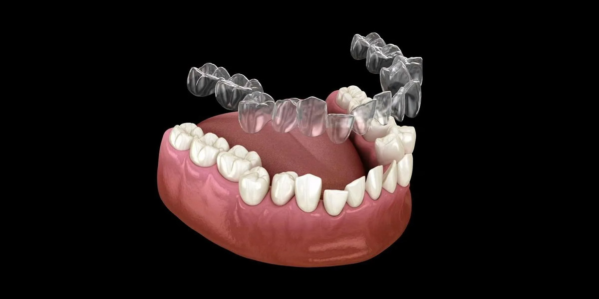 Wearing Clear Aligners