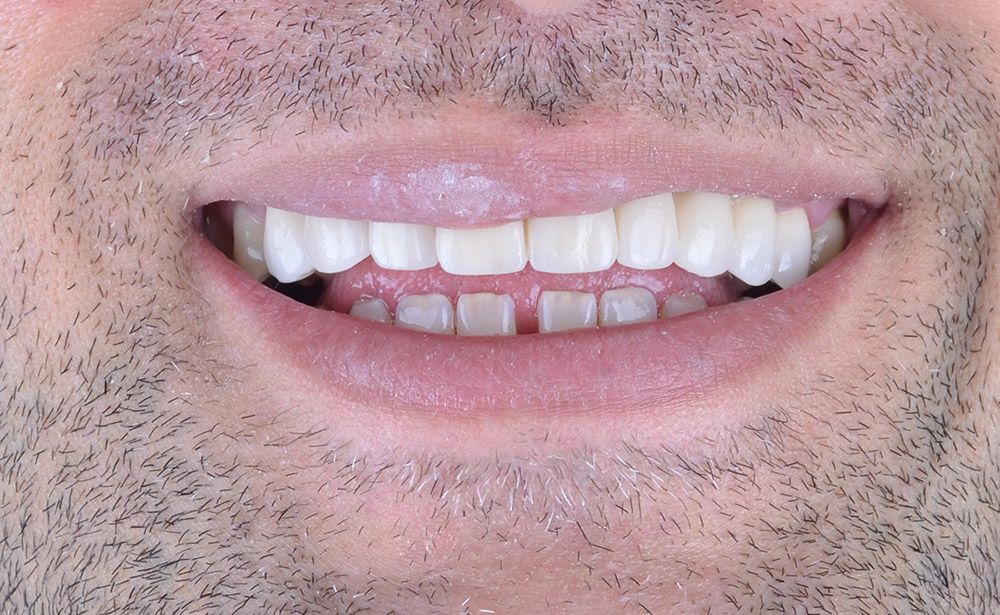 1 Ergunnes Zirconium Crowns After Ergunnes Zirconium Crowns After