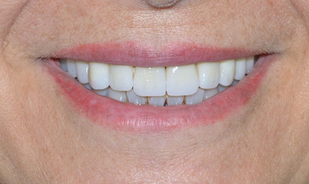 1 Georgiana Zirconium Crowns Treatment After Georgiana Zirconium Crowns Treatment After