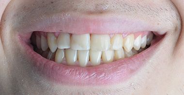 Glenn Invisalign After Smile in Turkey