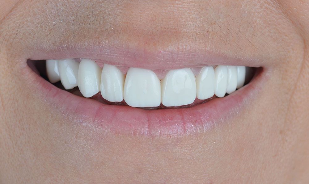 1 Hazal Zirconia Crowns Treatment After Hazal Zirconia Crowns Treatment
