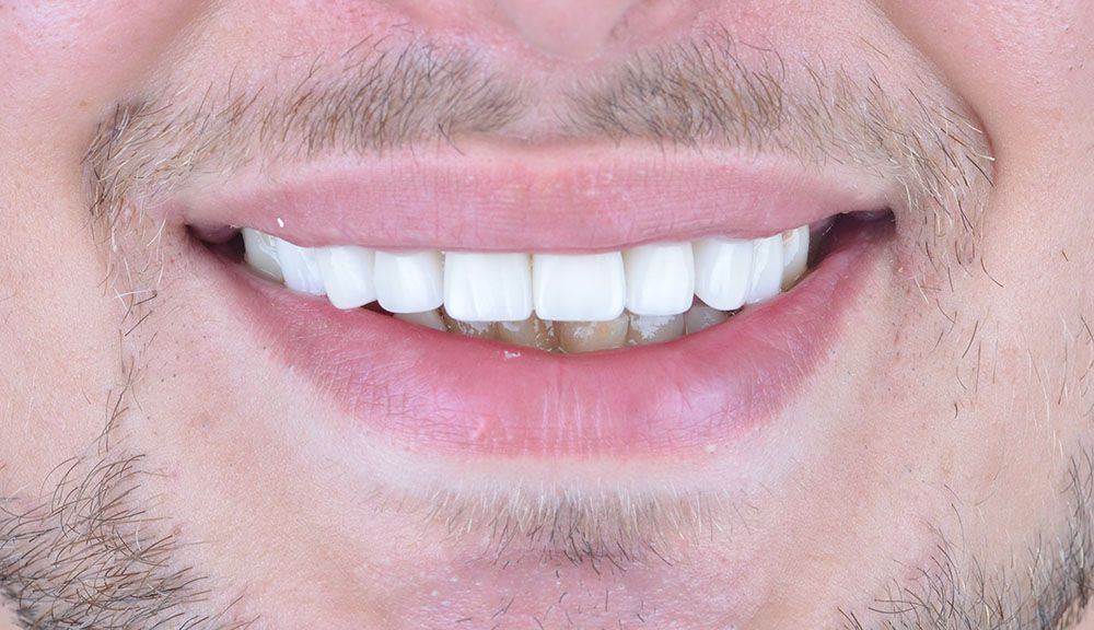 Jacob Zirconium Crowns Treatment in Turkey After