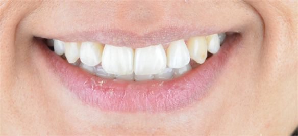 Luna After Invisalign Smile in Turkey