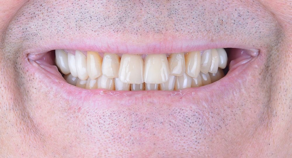 Maciej emax laminate smile makeover treatment in Turkey