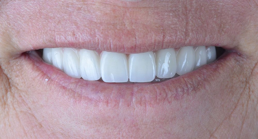 1 Marry all on four dental implants Marry all on four dental implants