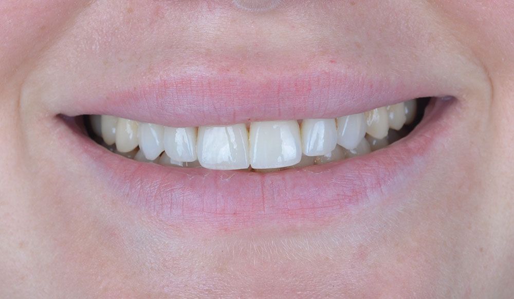 Melissa Laminate Veneer Treatment