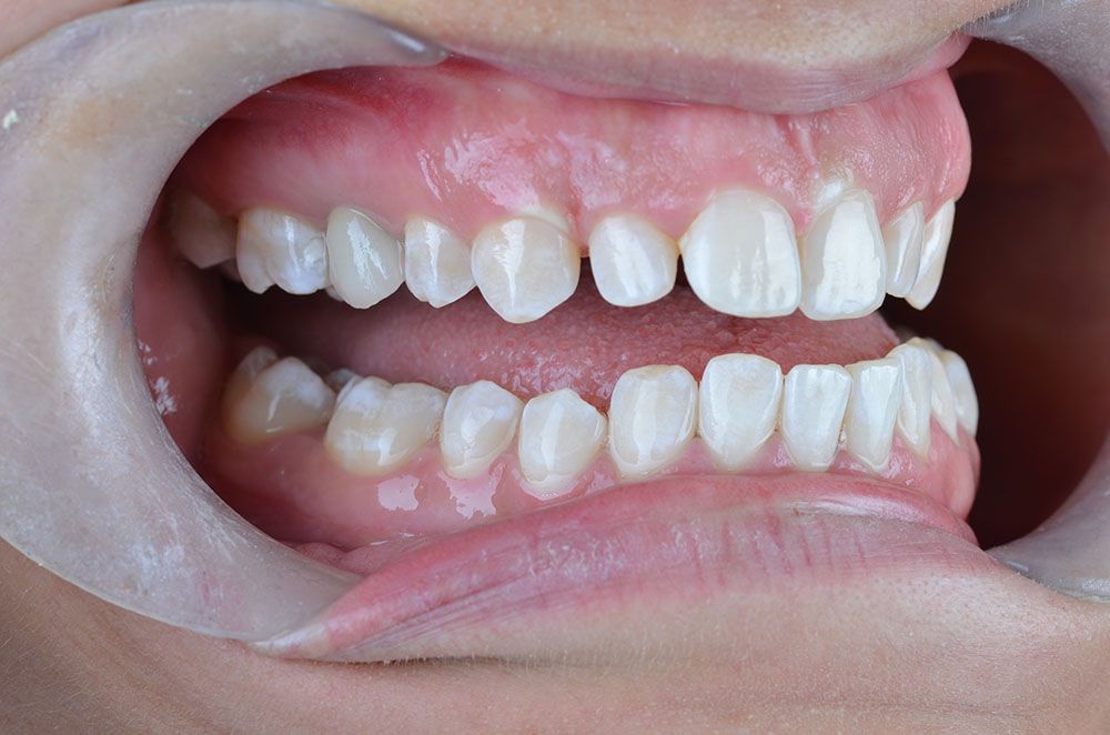 Pauline Zirconia Crown After Pauline Zirconia Crown After