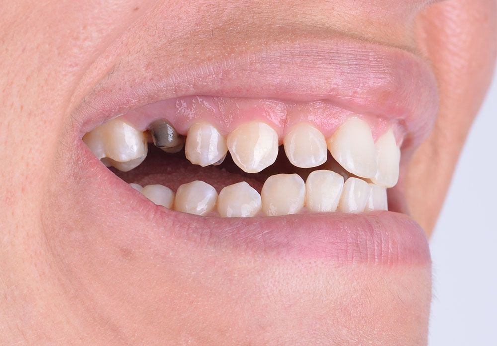 Pauline Zirconia Crown Before Pauline Zirconia Crown Before