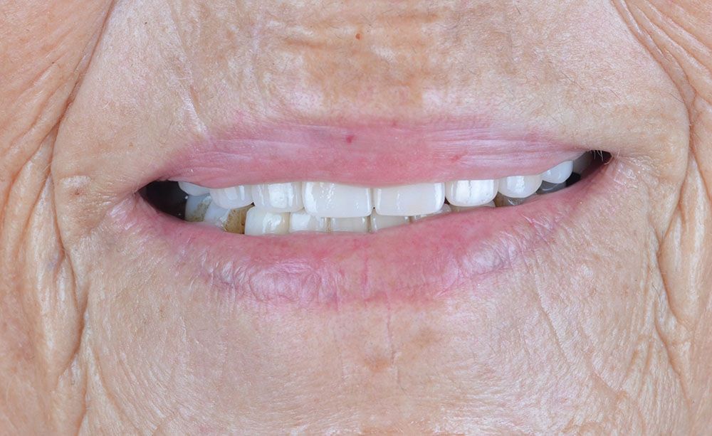 Samantha All on Four Dental Implants