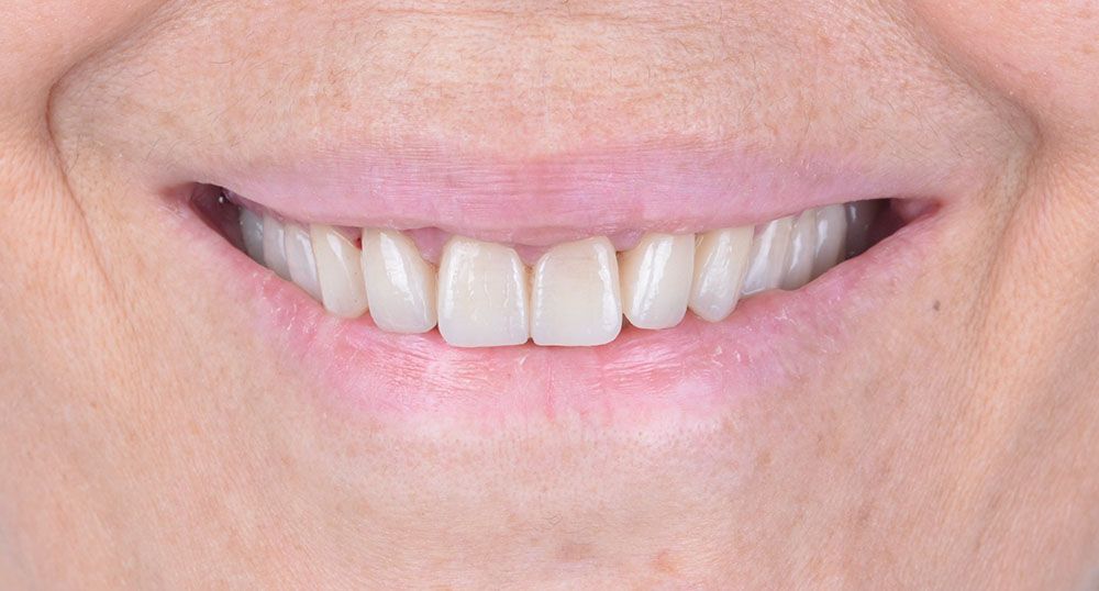 Yusra Zirconium Crowns Treatment