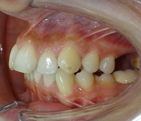 Luna Before Invisalign Sp Re2