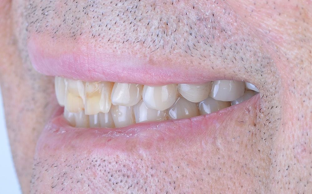 Maciej emax laminate smile makeover treatment in Turkey
