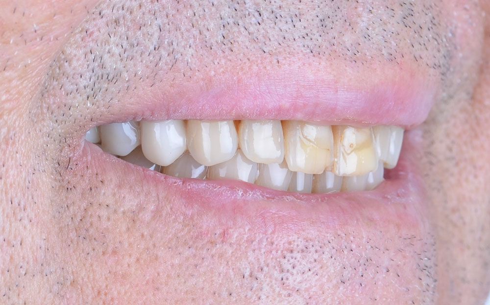 Maciej emax laminate smile makeover treatment in Turkey