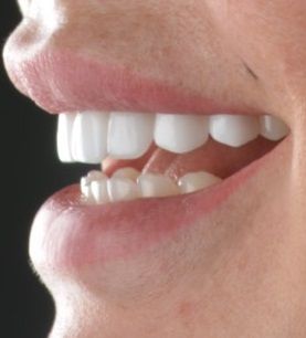 Elena Smilemakeover Turkey Teeth