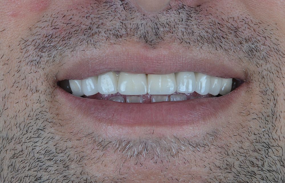 2 Ergunnes Zirconium Crowns After Ergunnes Zirconium Crowns After