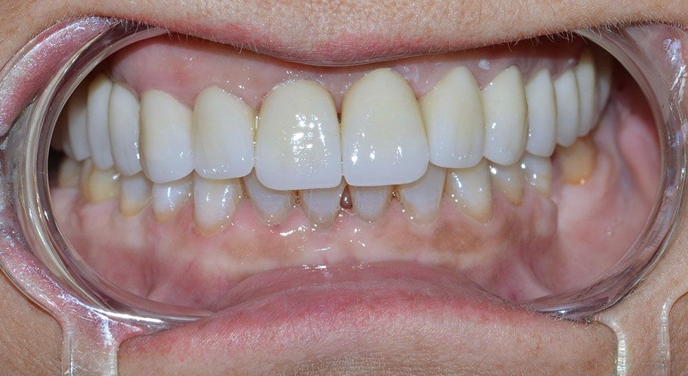 2 Georgiana Zirconium Crowns Treatment After Georgiana Zirconium Crowns Treatment After