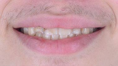 Glenn Invisalign Before Smile