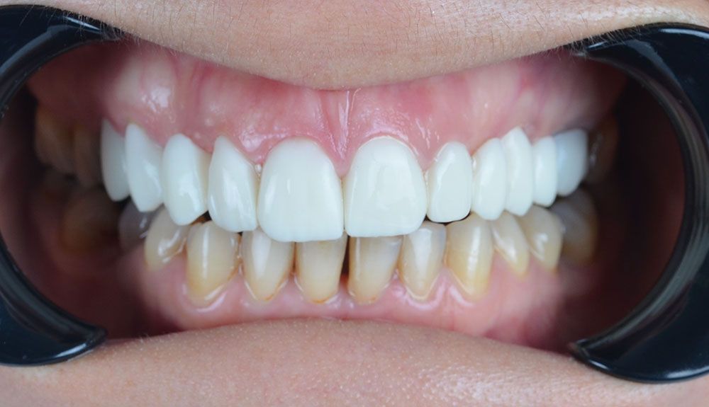 Hazal Zirconia Crowns Treatment