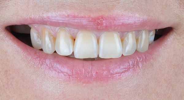 Isabella Missing Tooth Dental Implants Metal Porcelain Crowns