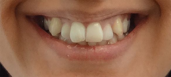 Luna Before Invisalign Smile