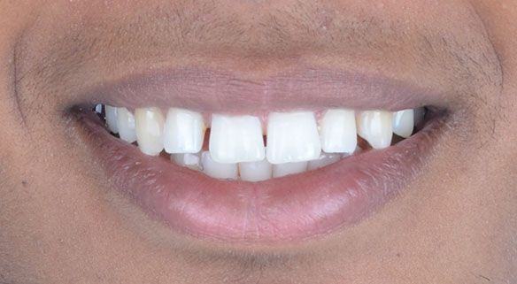 Manuel Before Invisalign in Turkey