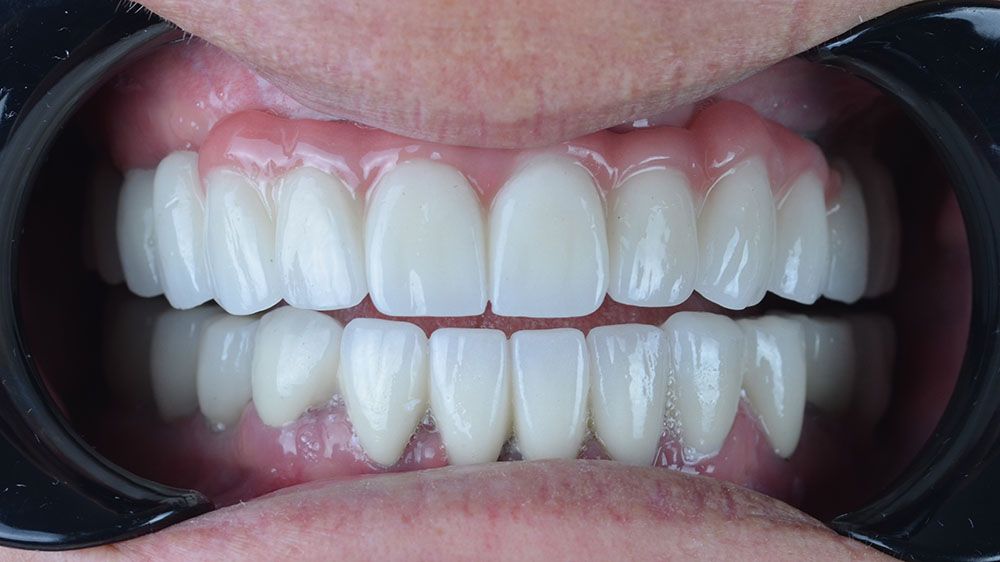 2 Marry all on four dental implants Marry all on four dental implants