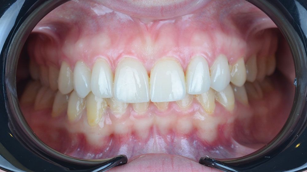 Melissa Laminate Veneer Treatment