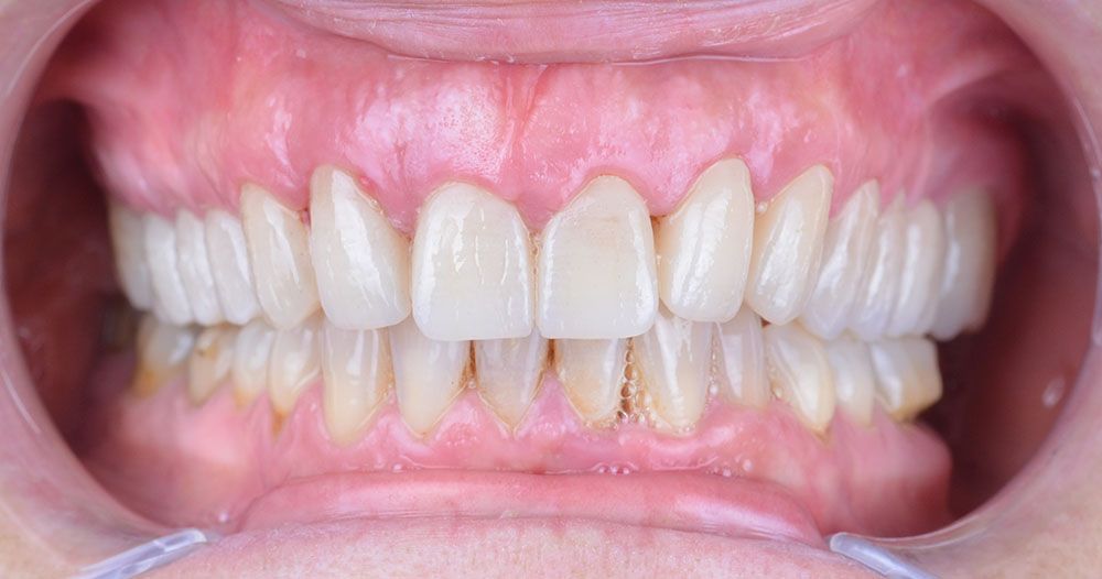 Yusra Zirconium Crowns Treatment
