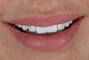 Elena Smilemakeover Turkey Teeth