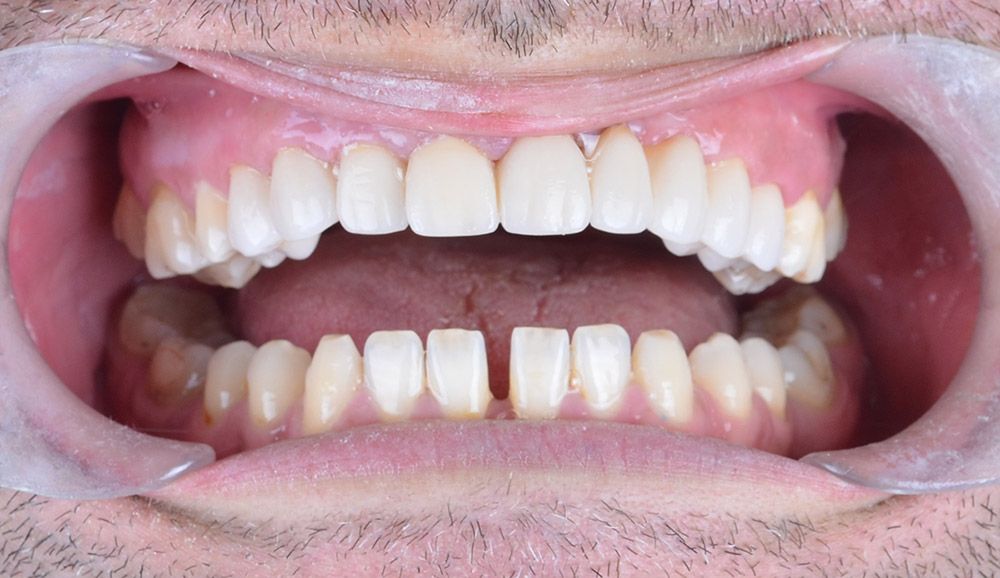 3 Ergunnes Zirconium Crowns After Ergunnes Zirconium Crowns After