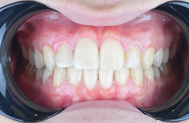 Glenn Invisalign After Turkey sp fr