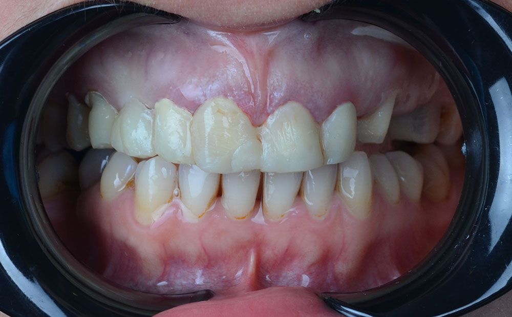Hazal Zirconia Crowns Treatment
