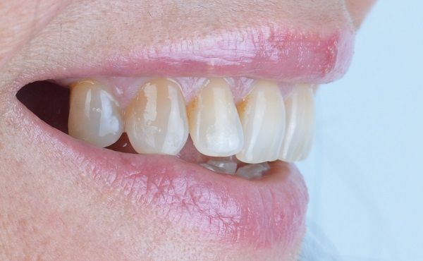 Isabella Missing Tooth Dental Implants Metal Porcelain Crowns