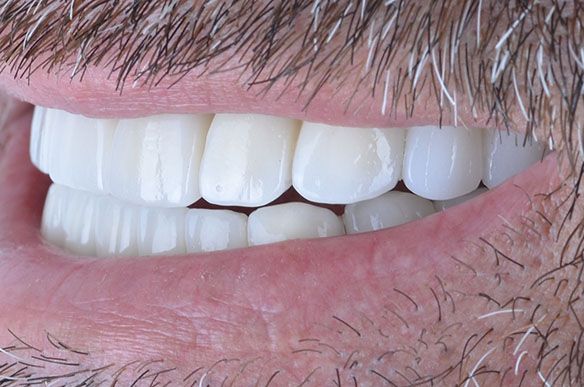 Jonah Teeth Implants Turkey Jonah Teeth Implants Turkey