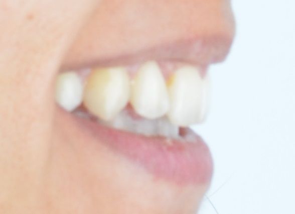 Luna After Invisalign Rear