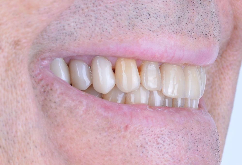 Maciej emax laminate smile makeover treatment in Turkey